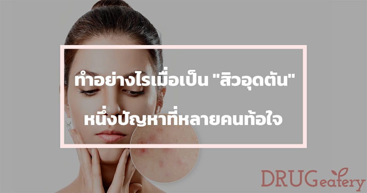 สิวอุดตัน