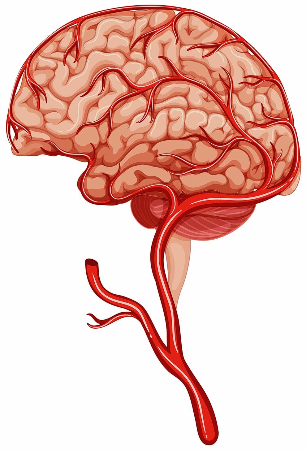 หลอดเลือดสมองตีบ เส้นเลือดตีบ