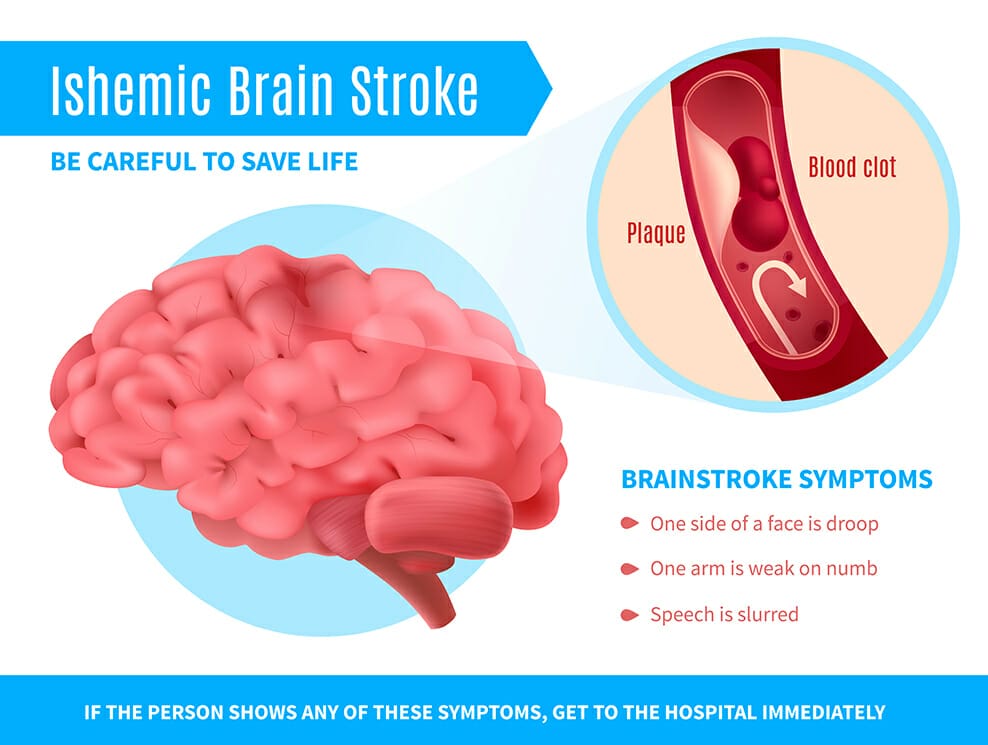 โรคเส้นเลือดในสมองตีบ ischemic stroke