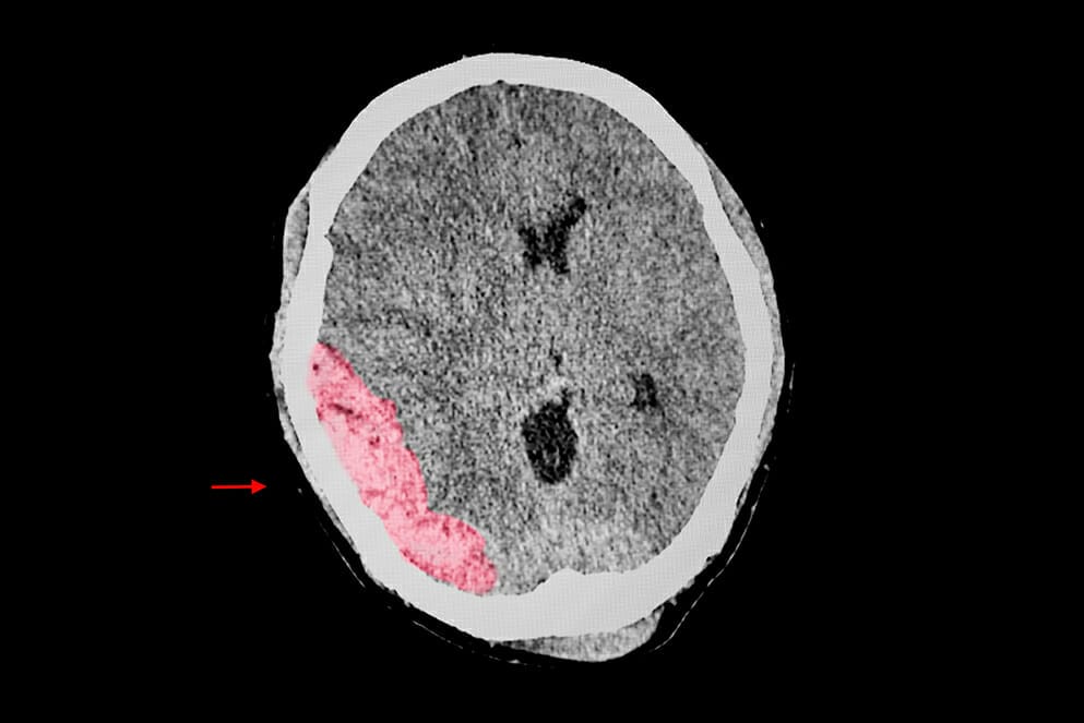 เส้นเลือดในสมองแตกเฉียบพลัน เลือดออกเหนือเยื่อหุ้มสมองชั้นนอก Epidural hemorrhage