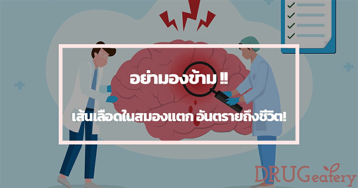 เส้นเลือดในสมองแตก