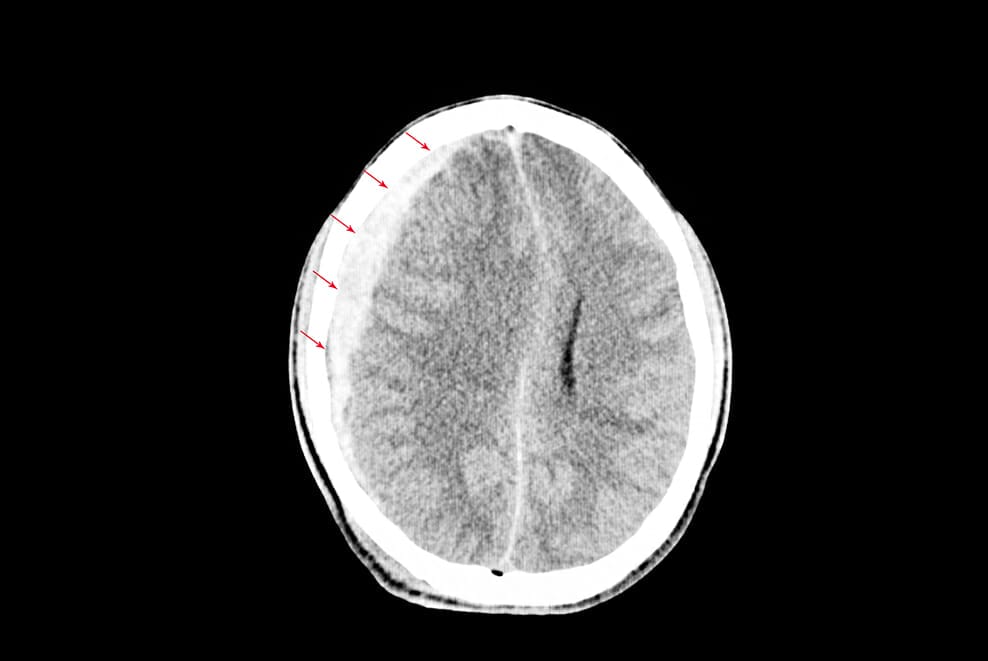 เส้นเลือดในสมองแตกเฉียบพลัน เลือดออกใต้เยื่อหุ้มสมองชั้นนอก Subdural hemorrhage